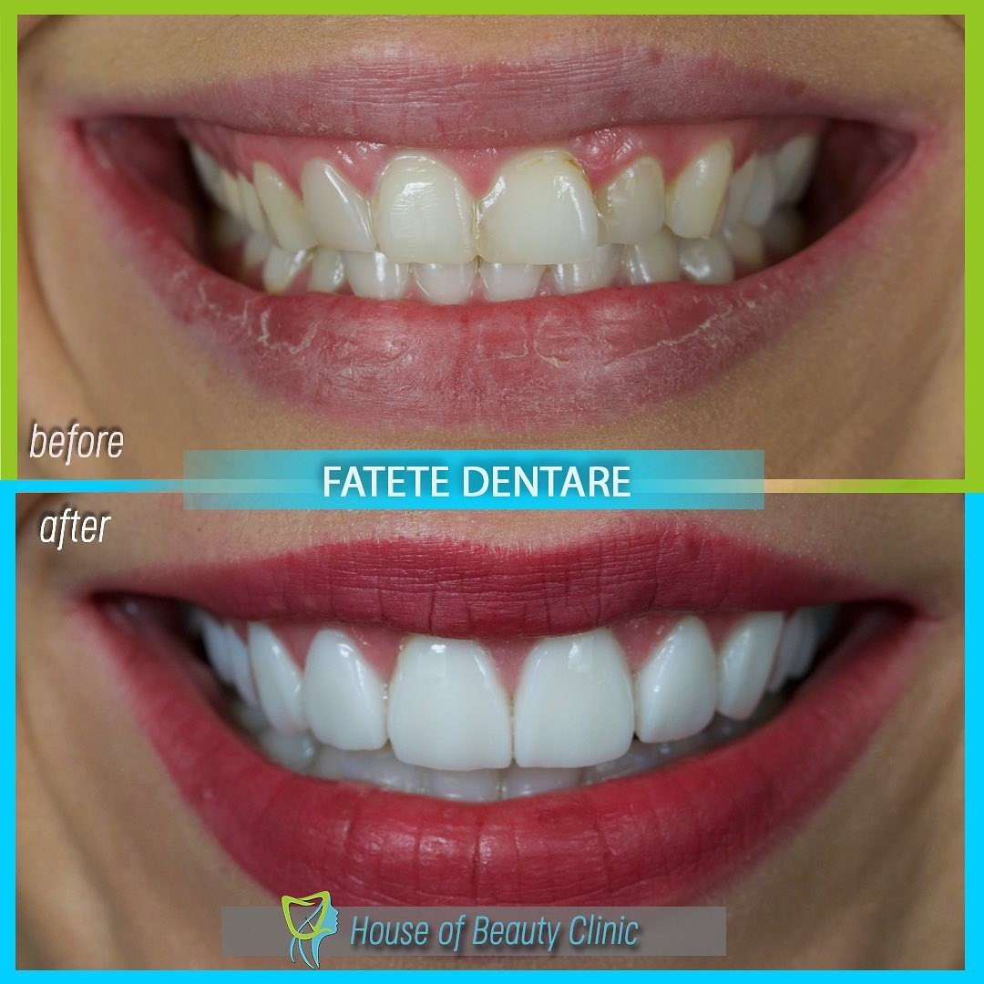 fatete dentare, house of beauty clinic