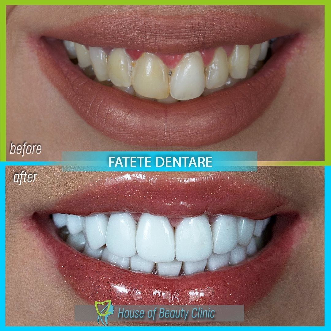 fatete dentare, house of beauty clinic, house of beauty clinic bucuresti, stomatologie bucuresti