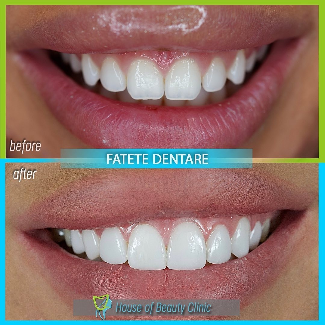 fatete dentare, house of beauty clinic, house of beauty clinic bucuresti