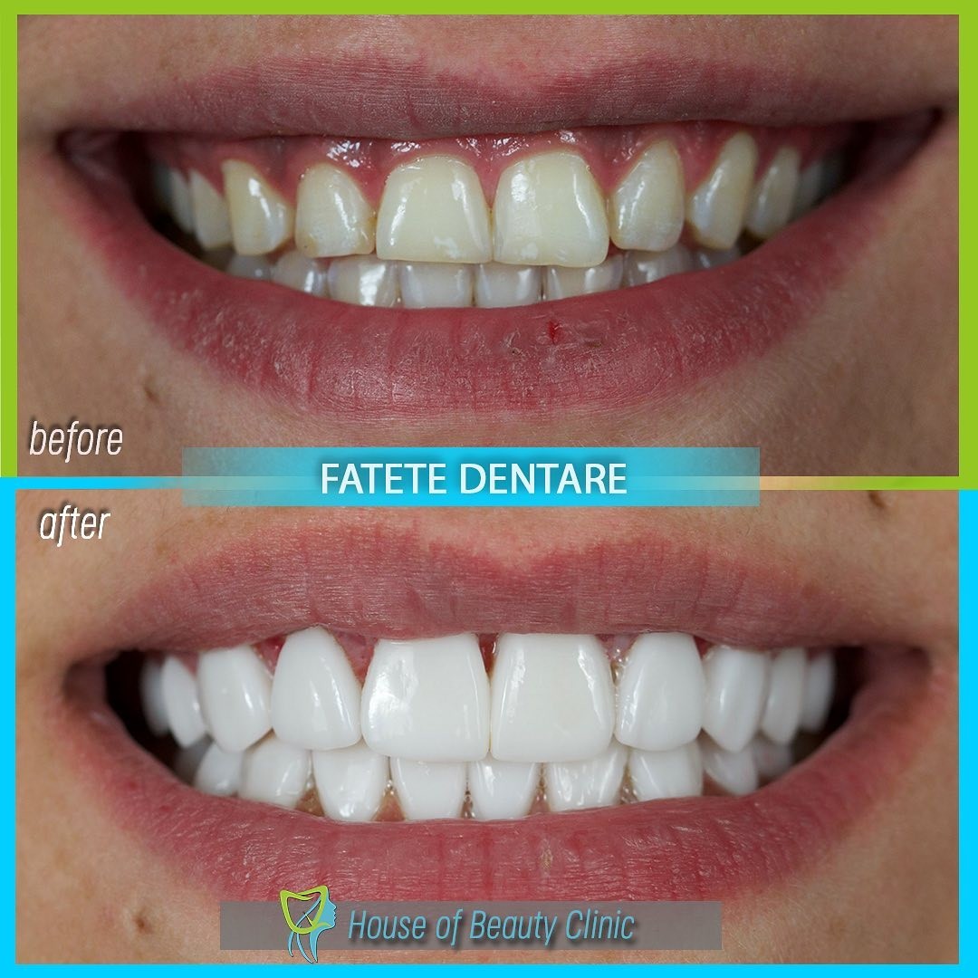 fatete dentare, house of beauty clinic, house of beauty clinic bucuresti, stomatologie bucuresti