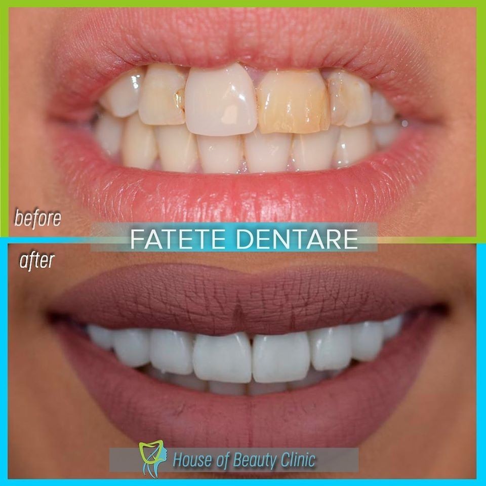 fatete dentare, clinica stomatologica house of beauty clinic