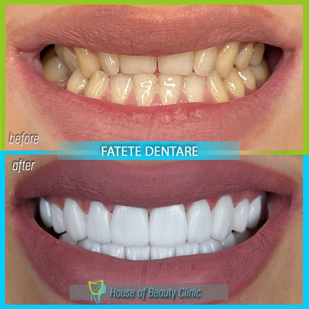 fatete dentare, house of beauty clinic, house of beauty clinic bucuresti, stomatologie pipera