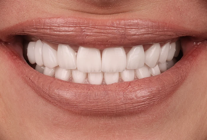 Hollywood Smile Plus