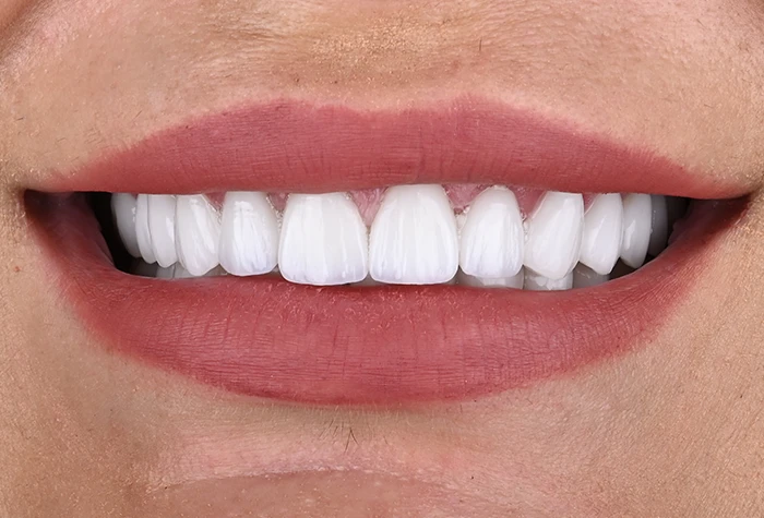 Hollywood Smile